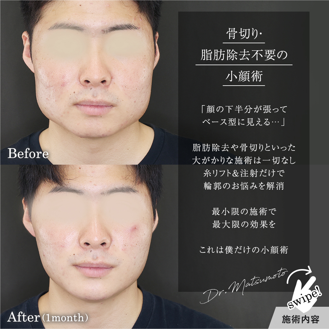 TAC式 ツヤ肌コラーゲンリフト®/エラボトックス注射/顎のヒアルロン酸注射の症例写真 施術前後 