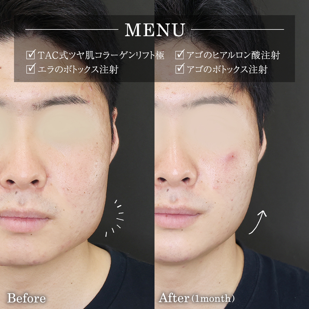 TAC式 ツヤ肌コラーゲンリフト®/エラボトックス注射/顎のヒアルロン酸注射の症例写真 施術前後 