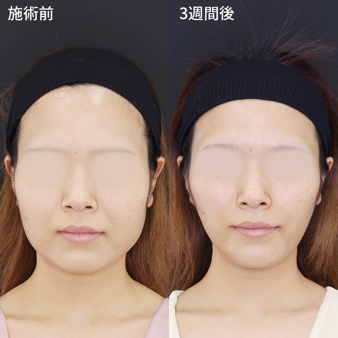 垢ぬけ小顔術！！　糸リフトで整った輪郭へ　