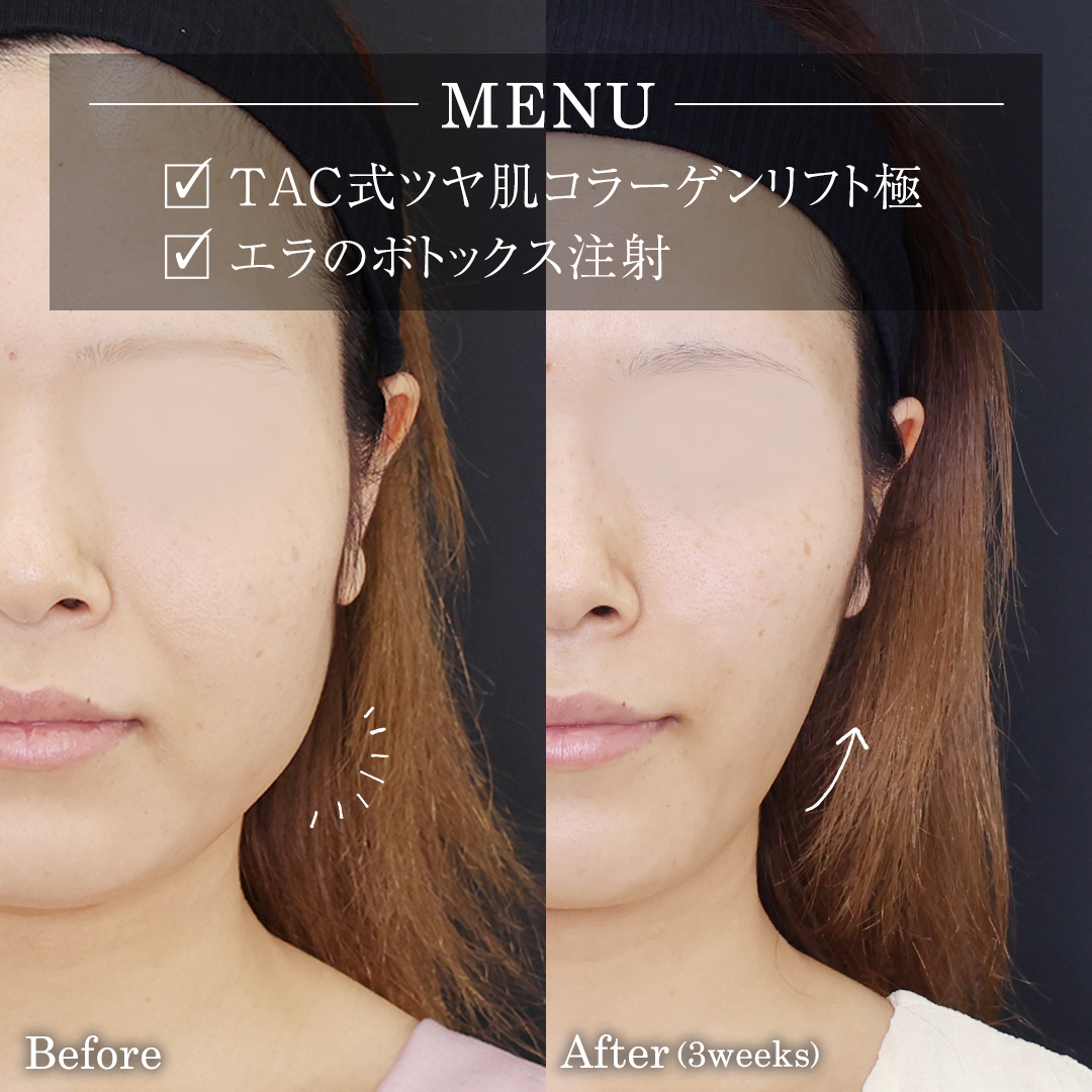 TAC式 ツヤ肌コラーゲンリフト®/エラボトックス注射の症例写真 施術前後 