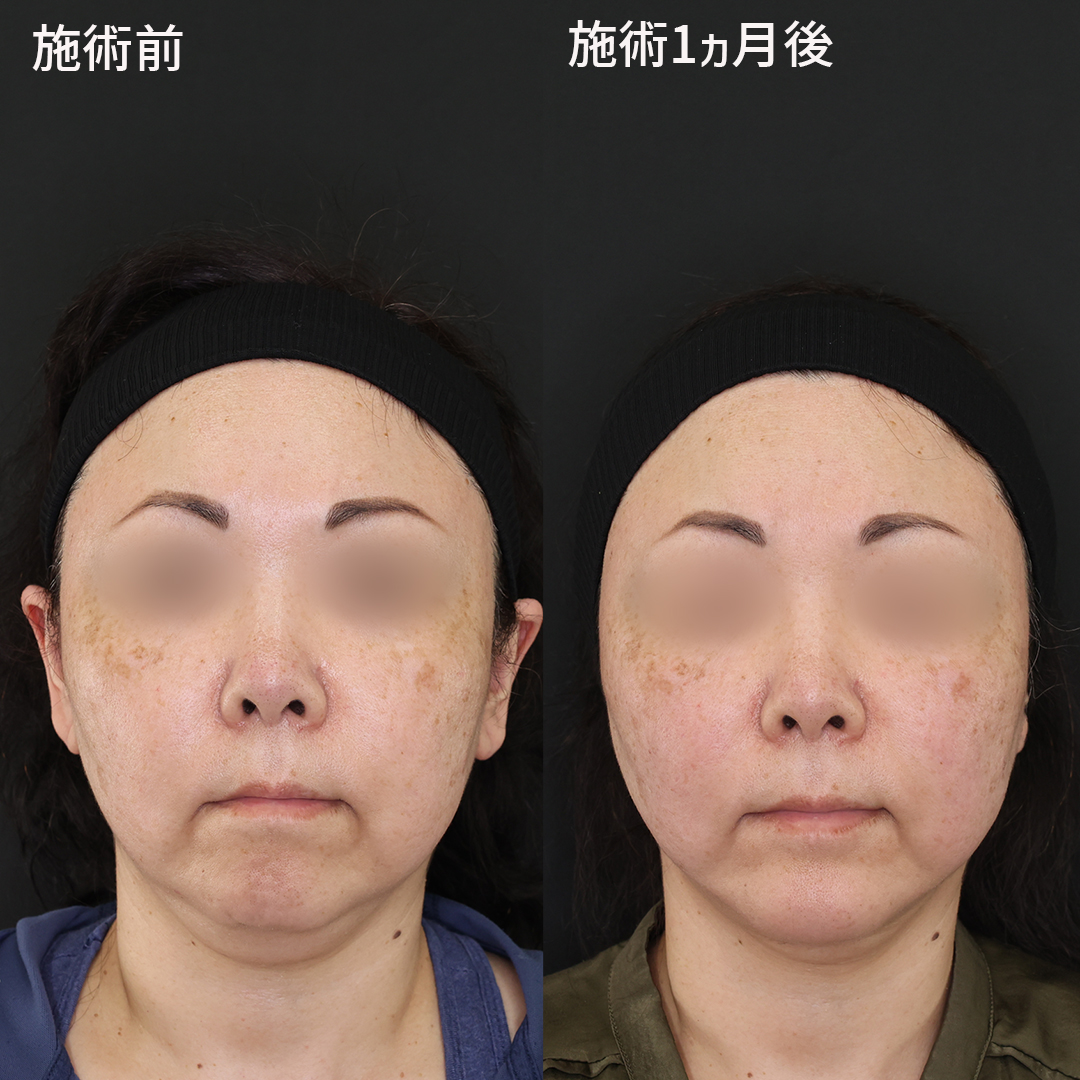 切らずに即小顔が実感できる糸リフト、ツヤ肌コラーゲンリフト®極