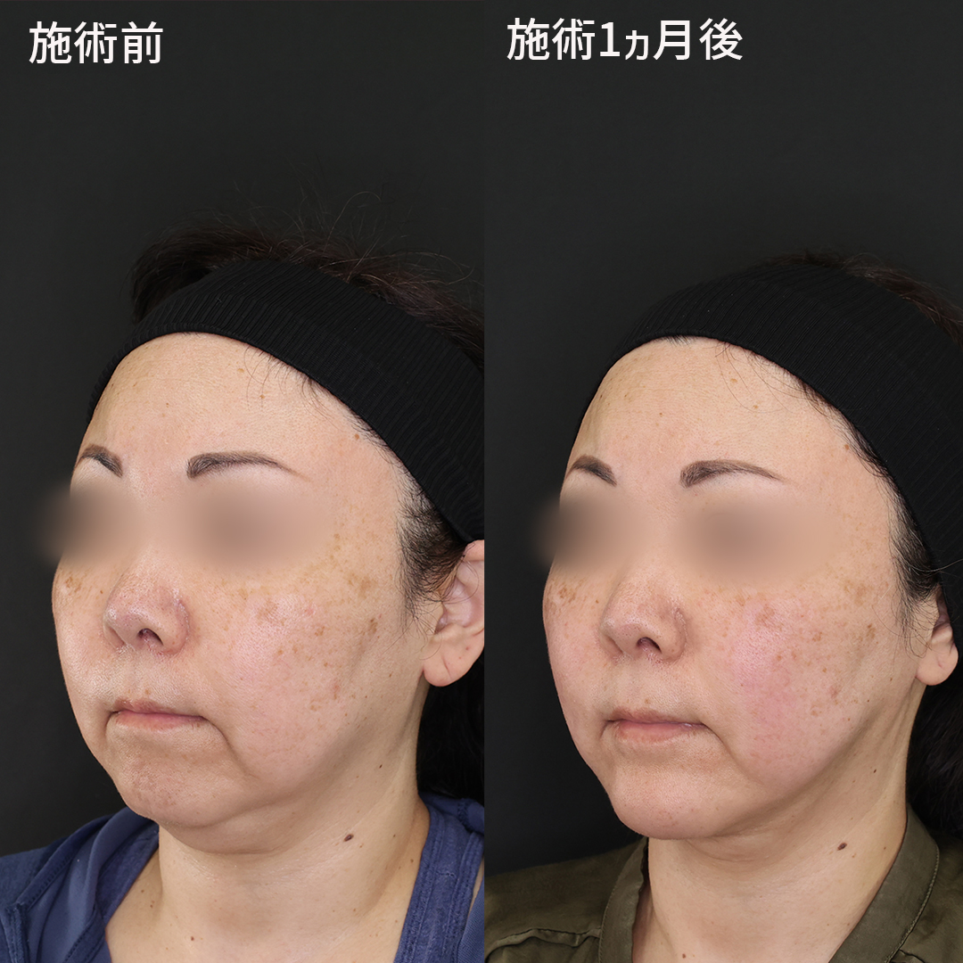 TAC式 ツヤ肌コラーゲンリフト®/顔の脂肪吸引/Lラインファット除去（エラ下脂肪除去）の症例写真 施術前後 