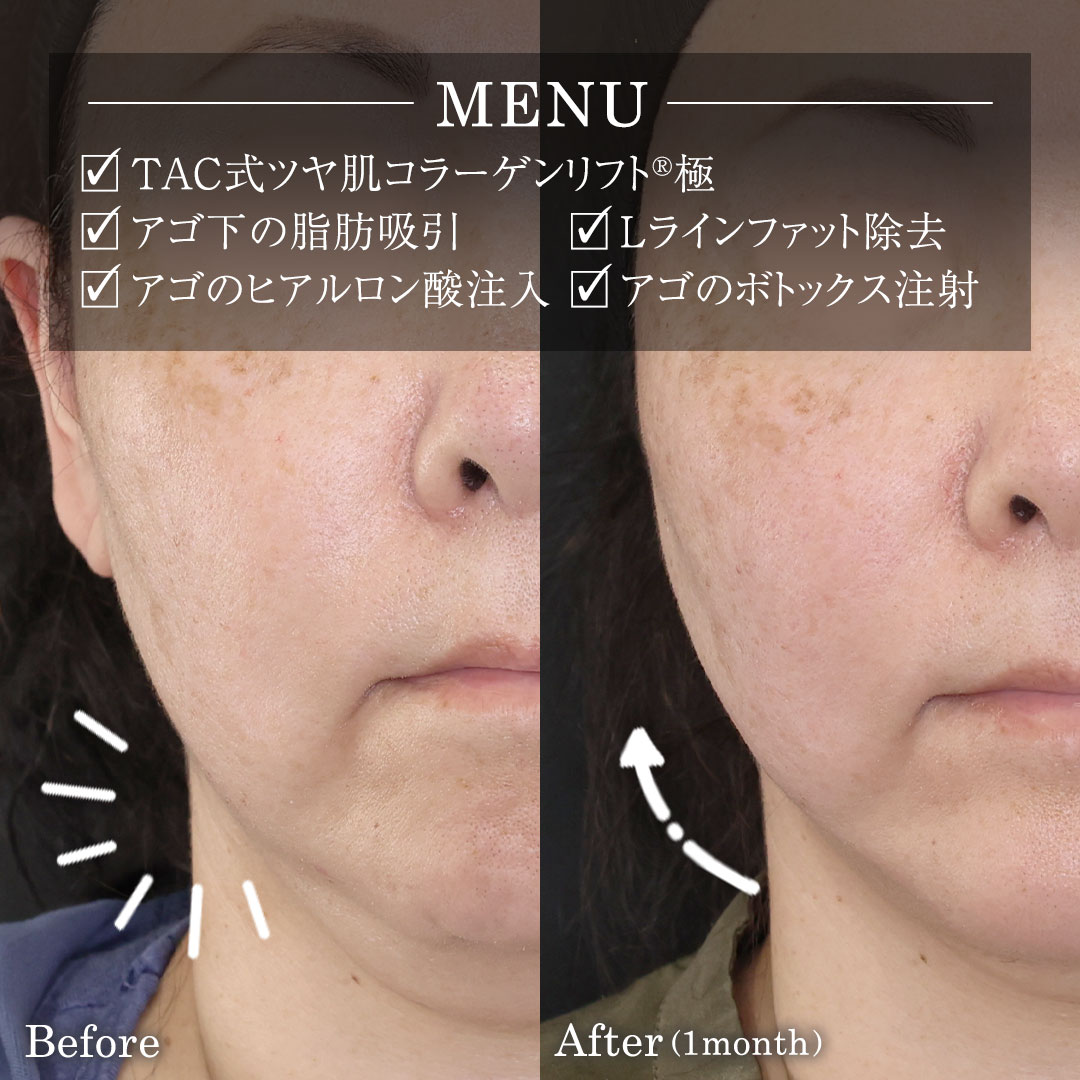 TAC式 ツヤ肌コラーゲンリフト®/顔の脂肪吸引/Lラインファット除去（エラ下脂肪除去）の症例写真 施術前後 