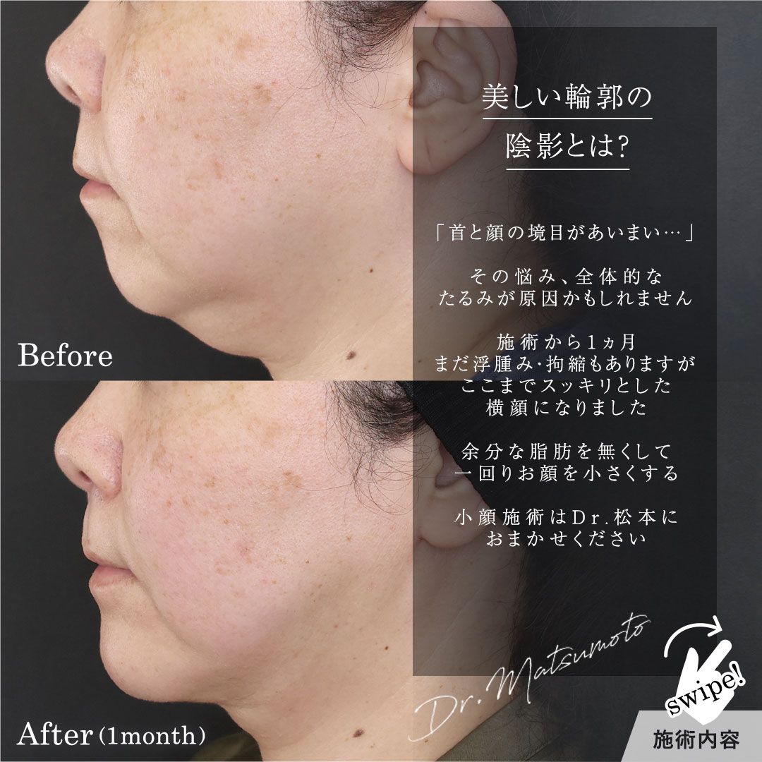 TAC式 ツヤ肌コラーゲンリフト®/顔の脂肪吸引/Lラインファット除去（エラ下脂肪除去）の症例写真 施術前後 