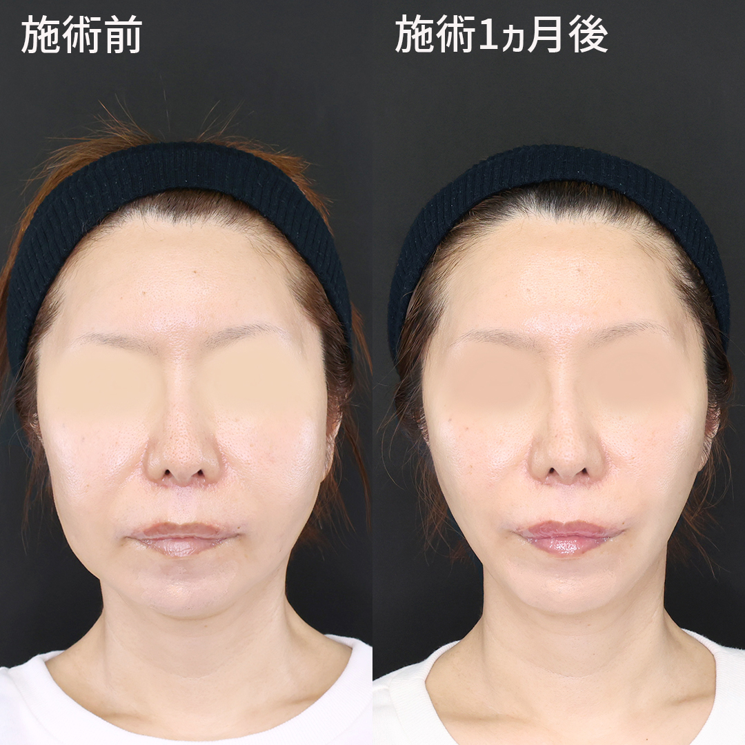 たるみ、もたつきゼロへ。エイジングケアの極み