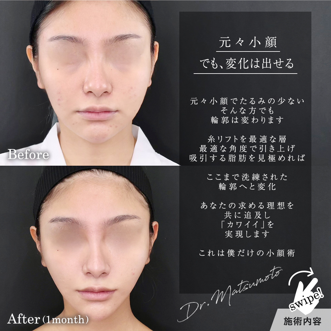 TAC式 ツヤ肌コラーゲンリフト®/顔の脂肪吸引の症例写真 施術前後 