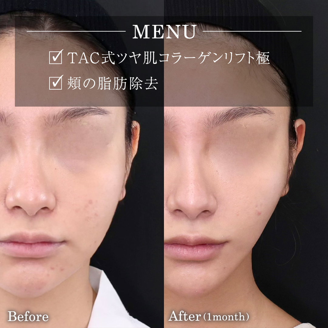 TAC式 ツヤ肌コラーゲンリフト®/顔の脂肪吸引の症例写真 施術前後 