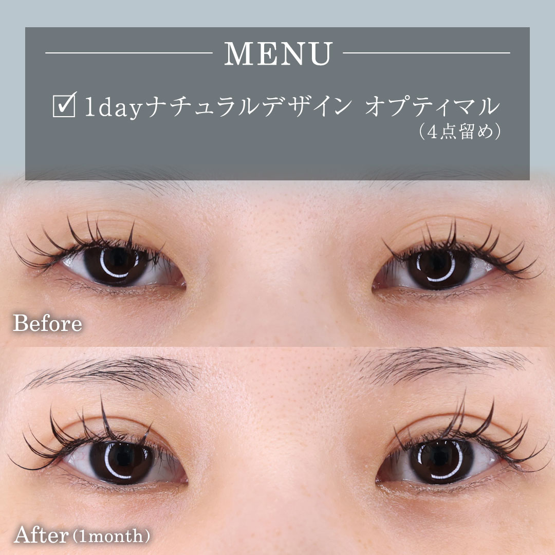 二重埋没法/目元:その他の症例写真 施術前後