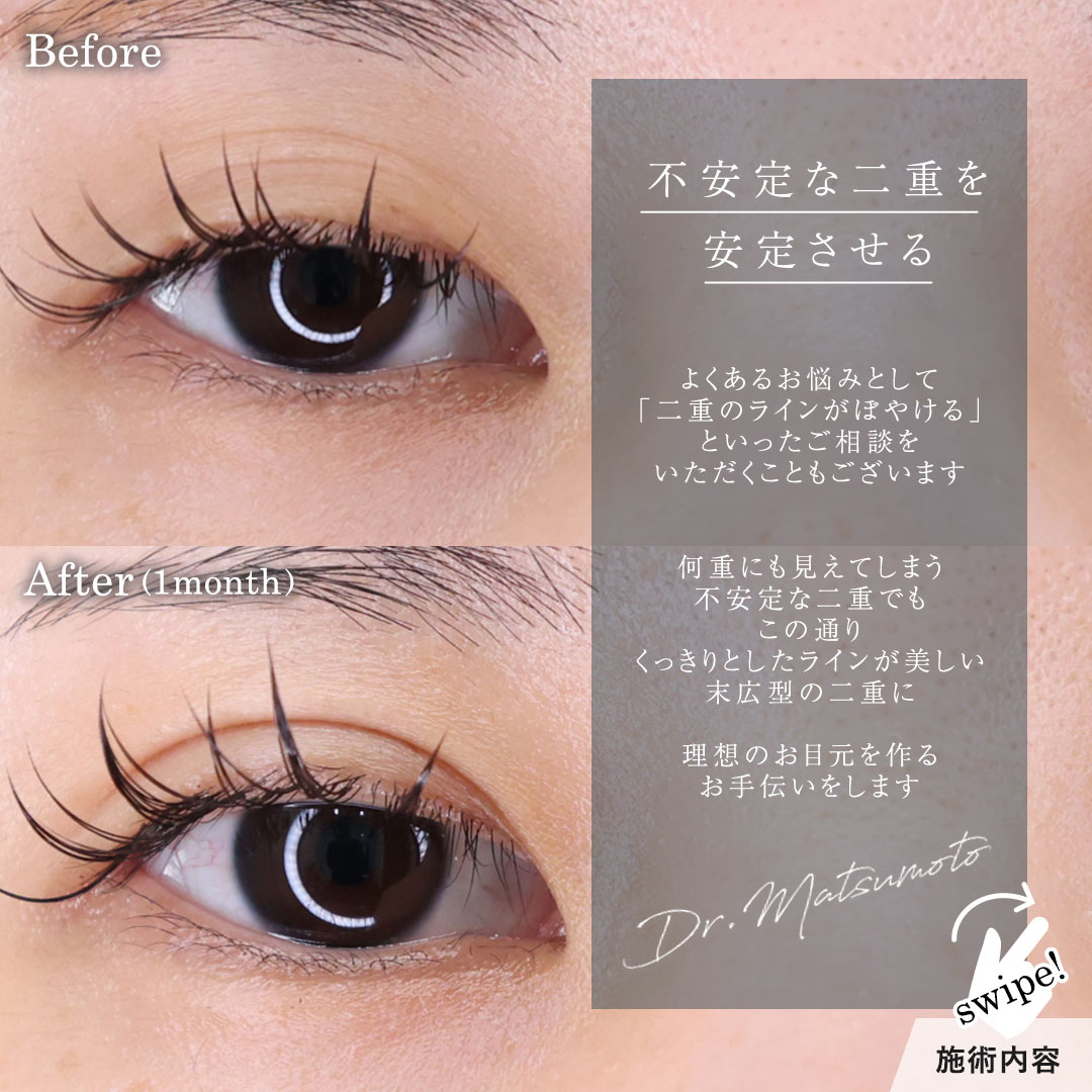 二重埋没法/目元:その他の症例写真 施術前後