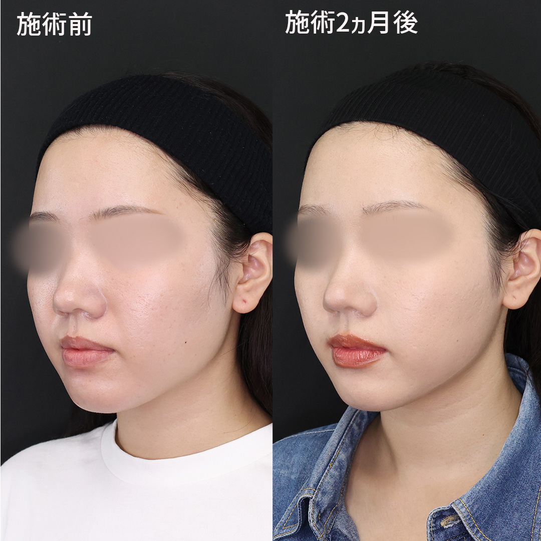 若いうちからのほうれい線予防