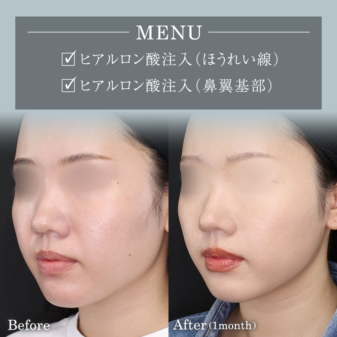 ほうれい線のヒアルロン酸注射/ヒアルロン酸注射：その他の症例写真 施術前後 