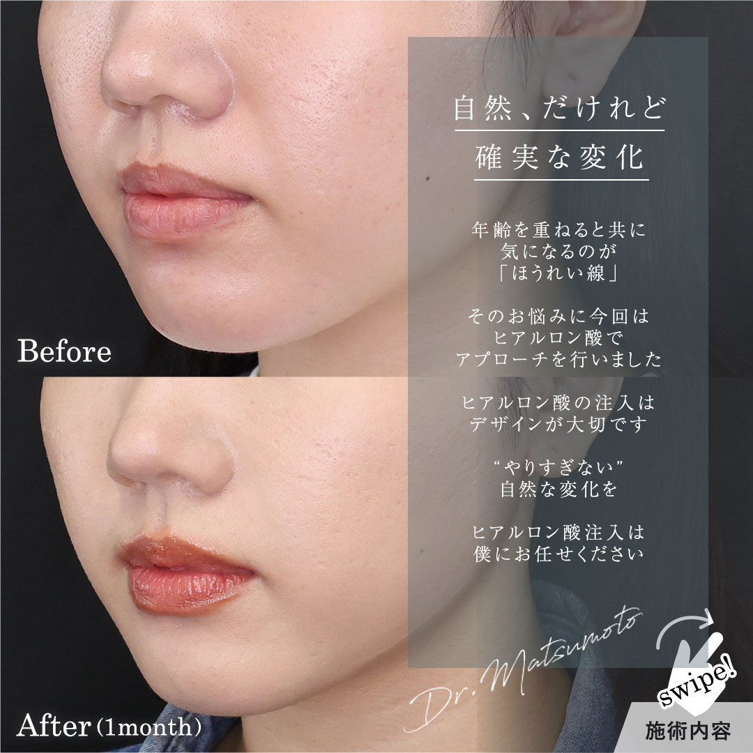 ほうれい線のヒアルロン酸注射/ヒアルロン酸注射：その他の症例写真 施術前後 