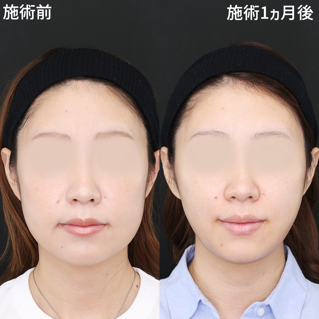 糸リフトで美しい卵型フェイスラインへ　【ツヤ肌コラーゲンリフト®極】