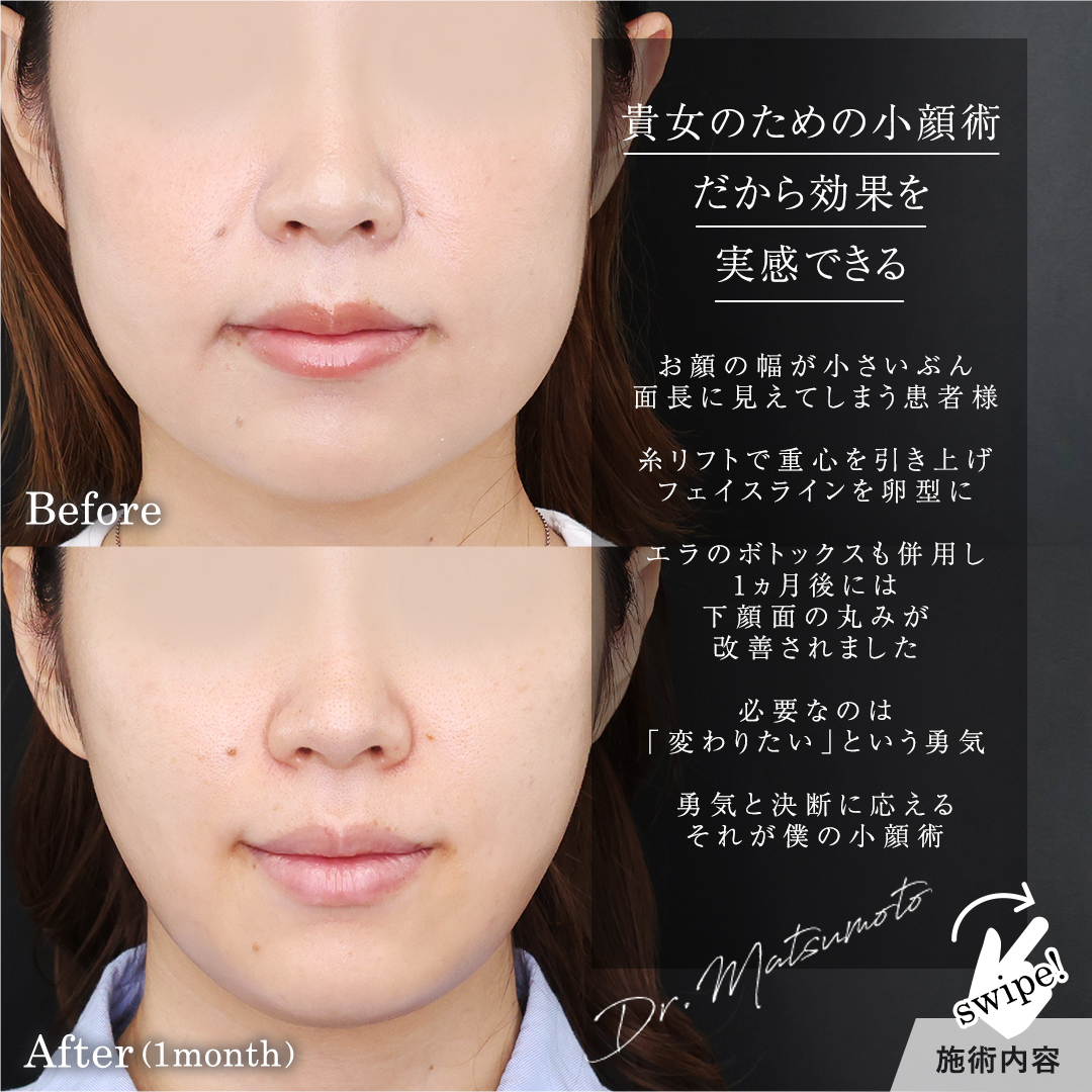 TAC式 ツヤ肌コラーゲンリフト®/エラボトックス注射の症例写真 施術前後 