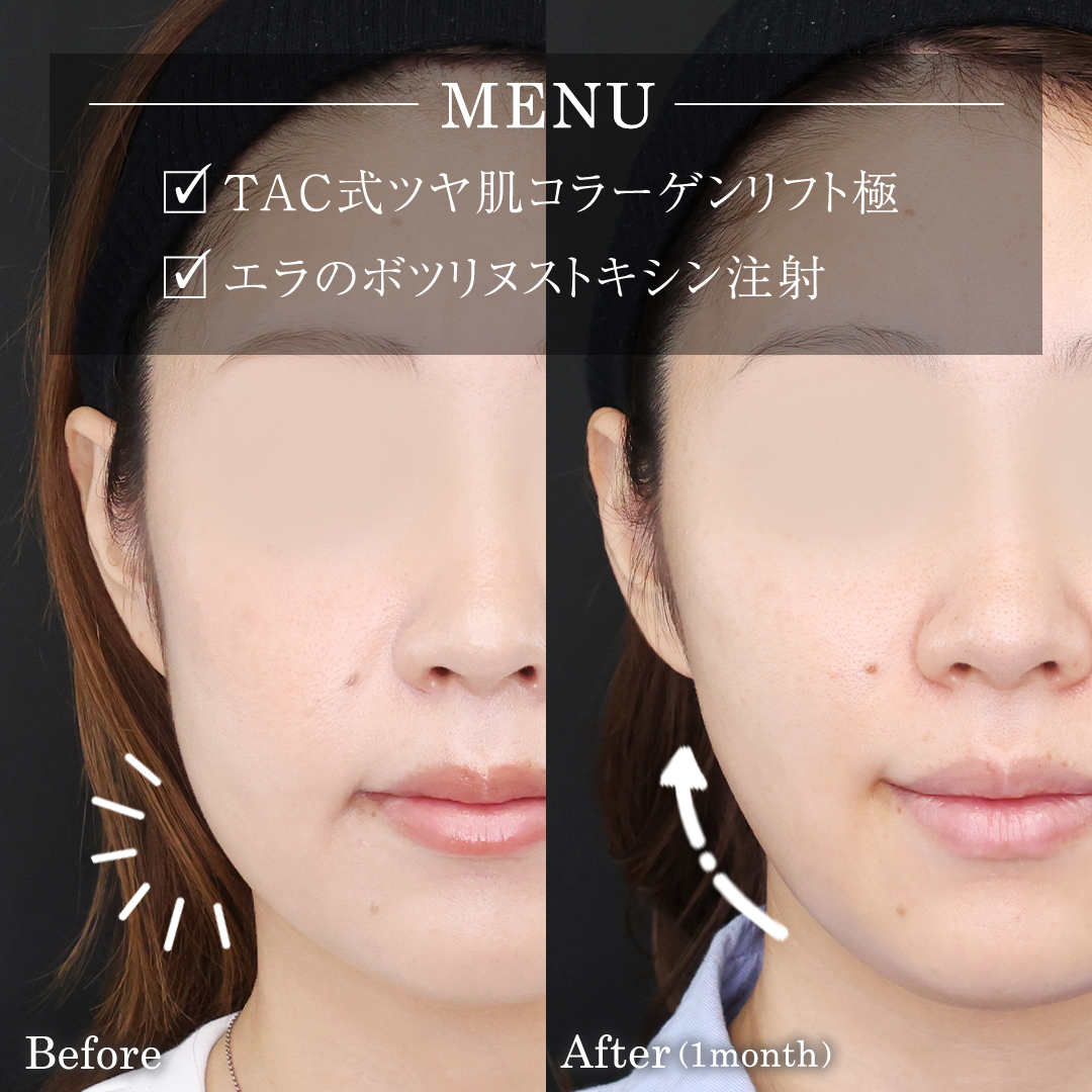 TAC式 ツヤ肌コラーゲンリフト®/エラボトックス注射の症例写真 施術前後 