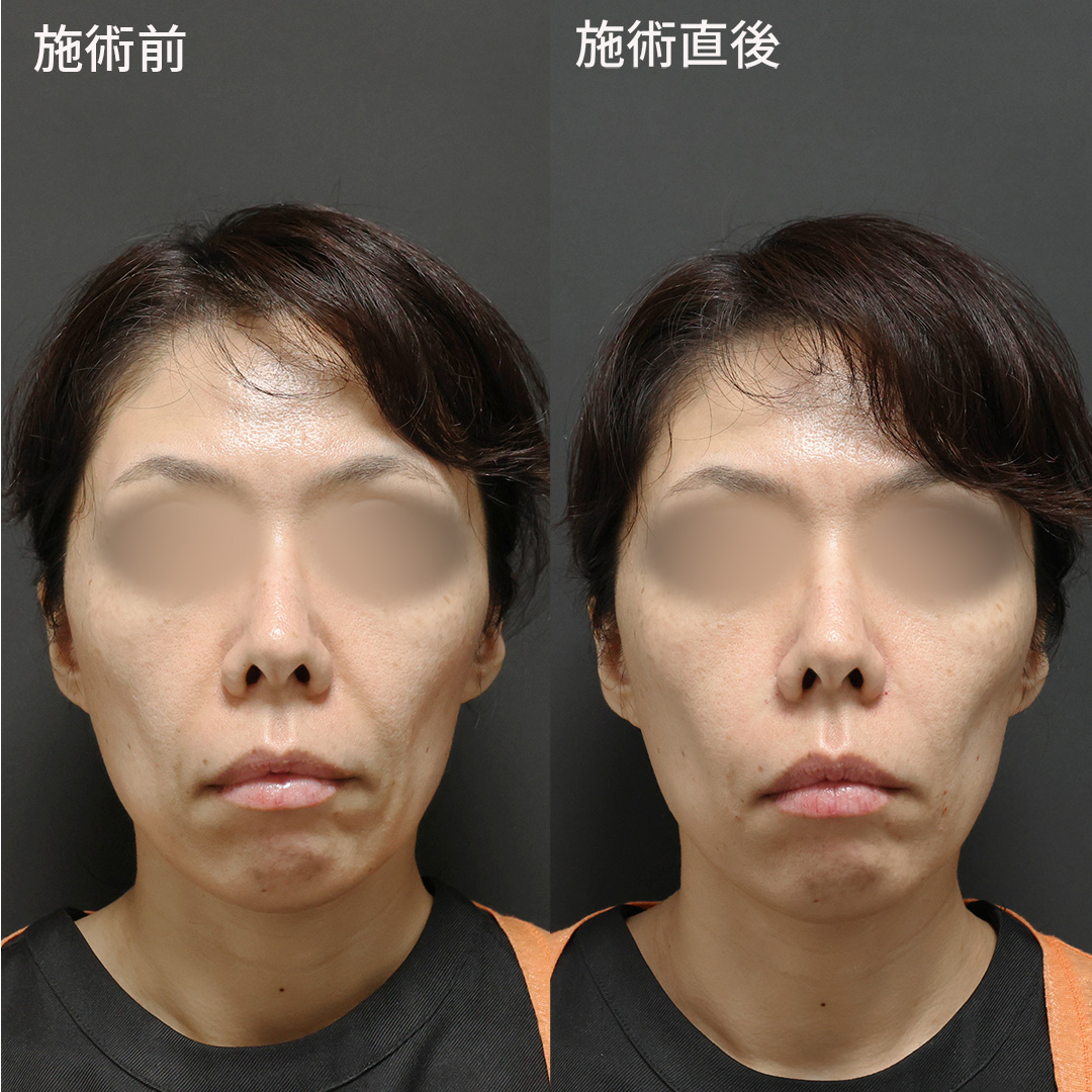 ほうれい線が目立たない。自然な変化で若返り