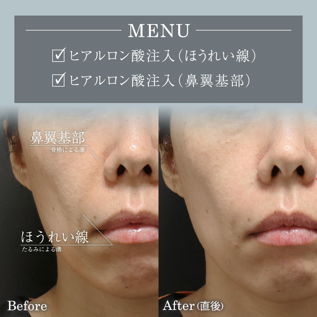 ほうれい線のヒアルロン酸注射の症例写真 施術前後 