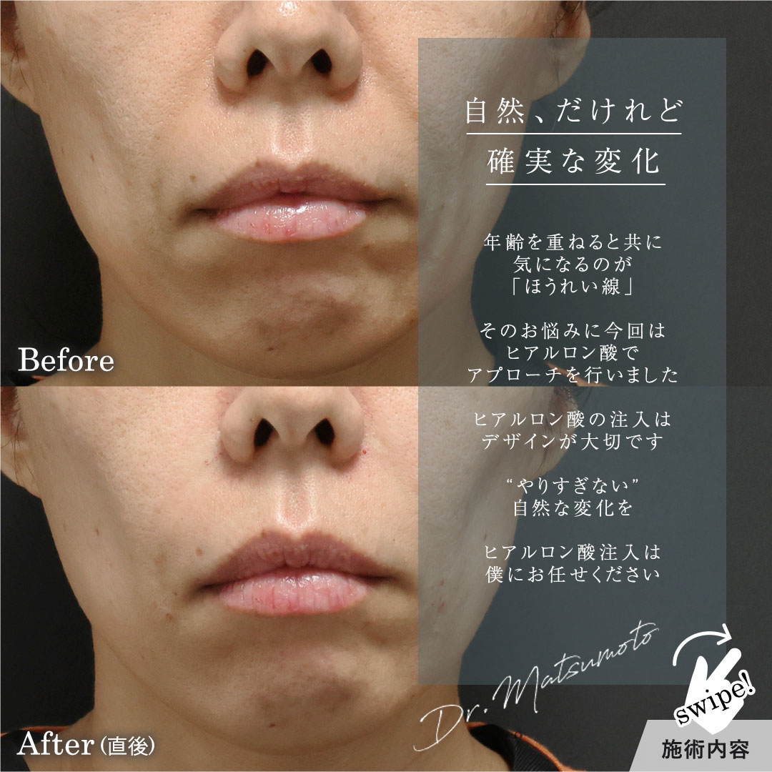 ほうれい線のヒアルロン酸注射の症例写真 施術前後 