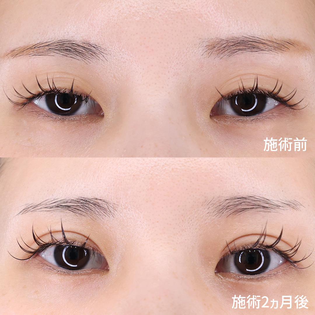 不安定な二重を安定させる。 理想の末広型二重に