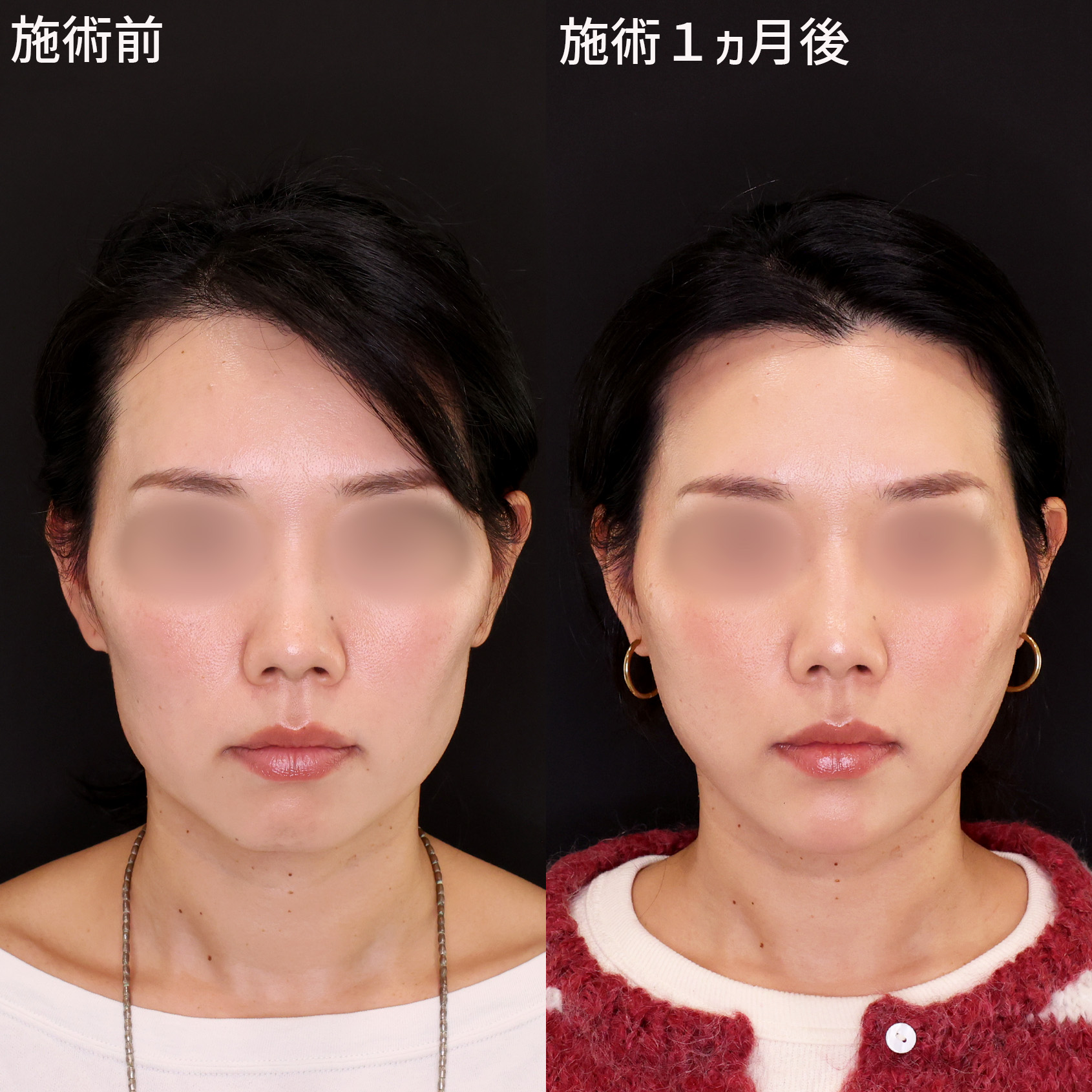 【小顔複合施術】ナチュラルな変化で別人級の輪郭を手に入れる