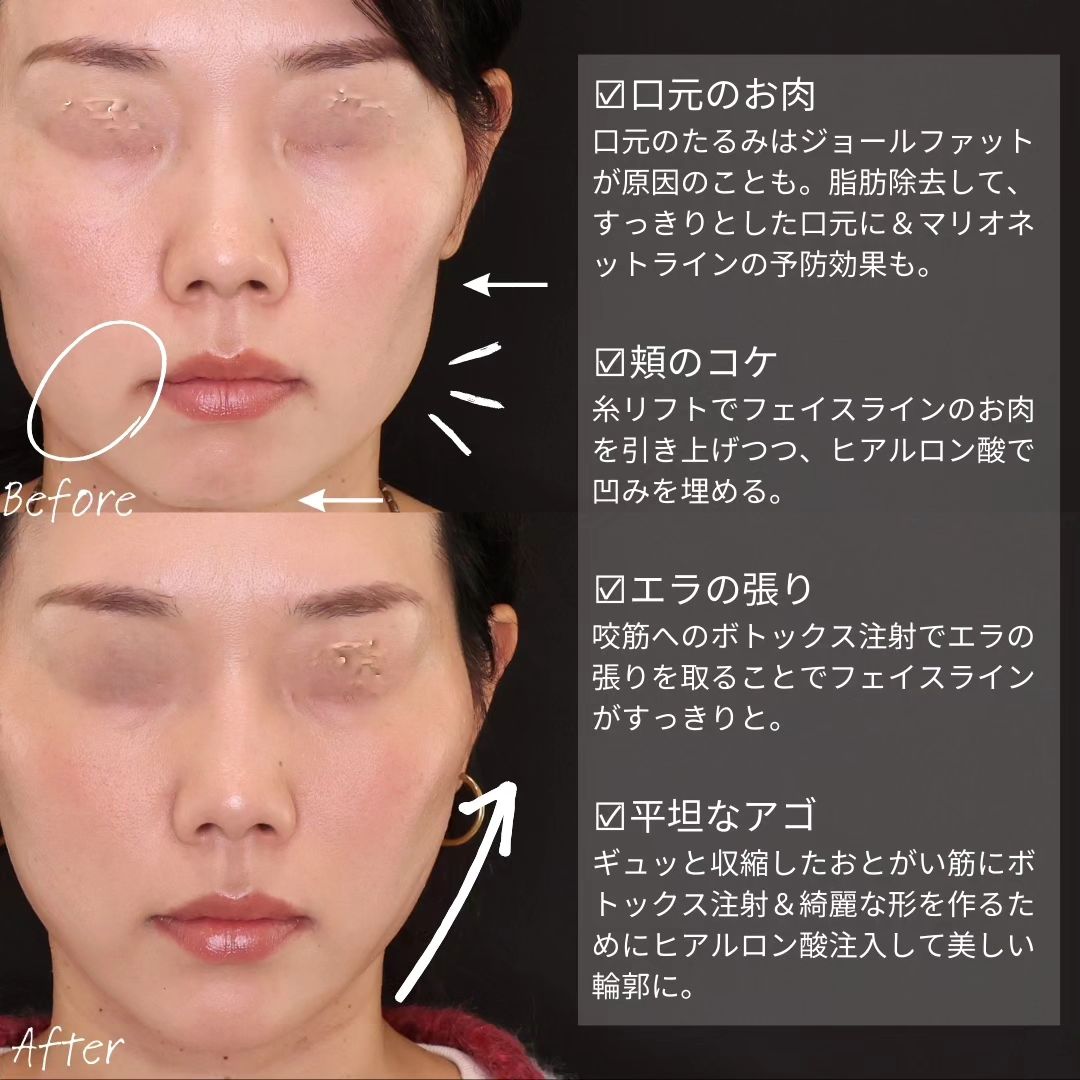 TAC式 ツヤ肌コラーゲンリフト®/ジョールファット除去/顎のヒアルロン酸注射の症例写真 施術前後 