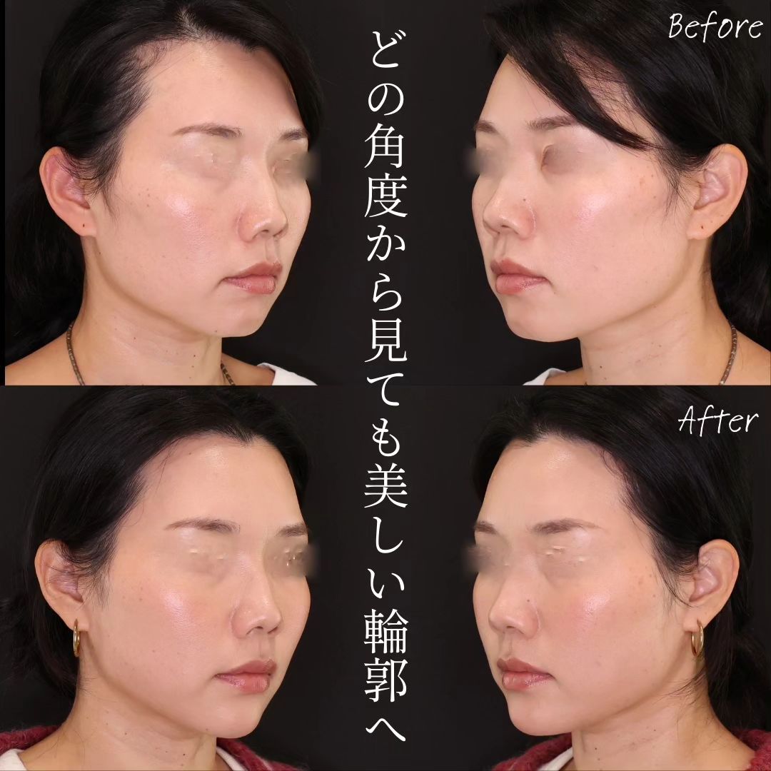 TAC式 ツヤ肌コラーゲンリフト®/ジョールファット除去/顎のヒアルロン酸注射の症例写真 施術前後 