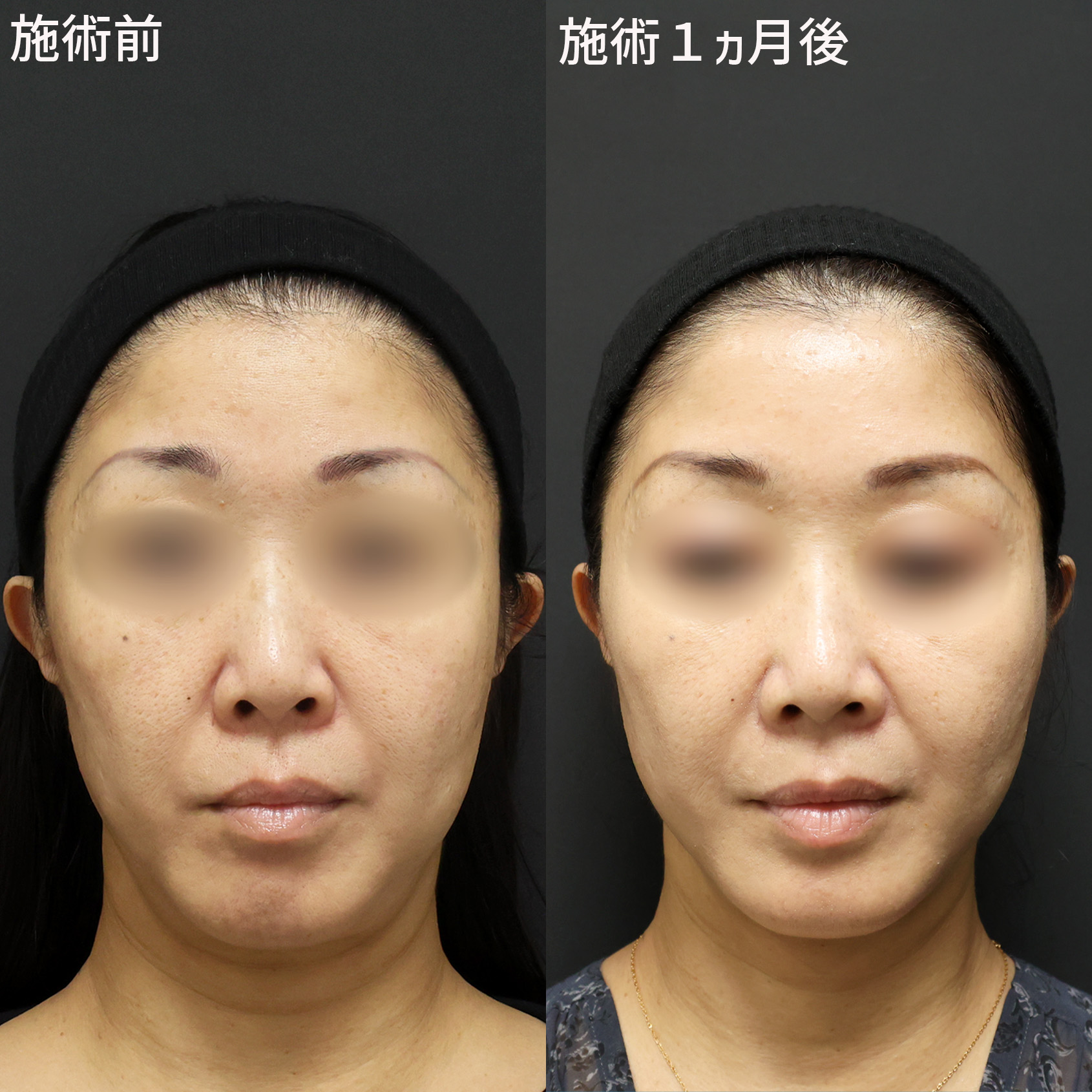 TAC式 ツヤ肌コラーゲンリフト®/ボトックス注射：その他の症例写真 施術前後 