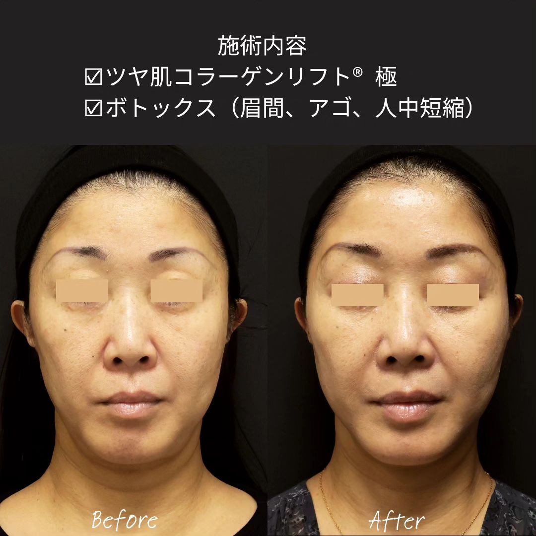 TAC式 ツヤ肌コラーゲンリフト®/ボトックス注射：その他の症例写真 施術前後 