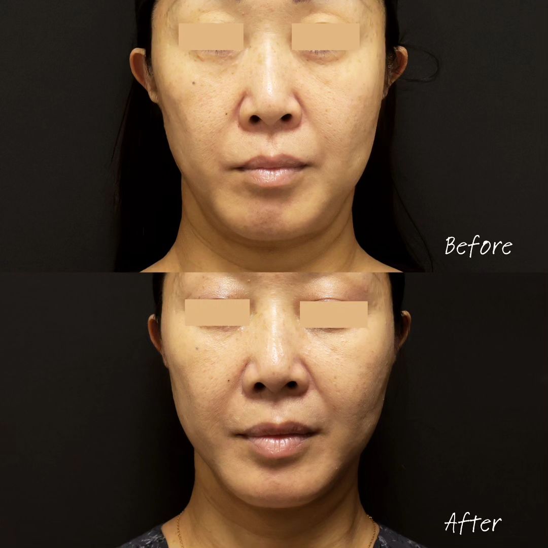 TAC式 ツヤ肌コラーゲンリフト®/ボトックス注射：その他の症例写真 施術前後 