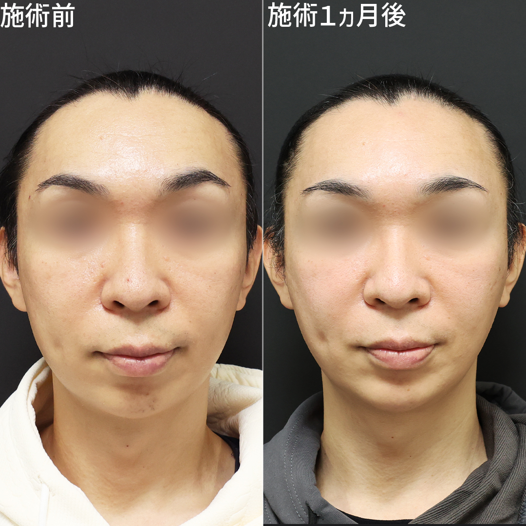 大人の男性の美容整形。ほうれい線の影を消して爽やかな印象に