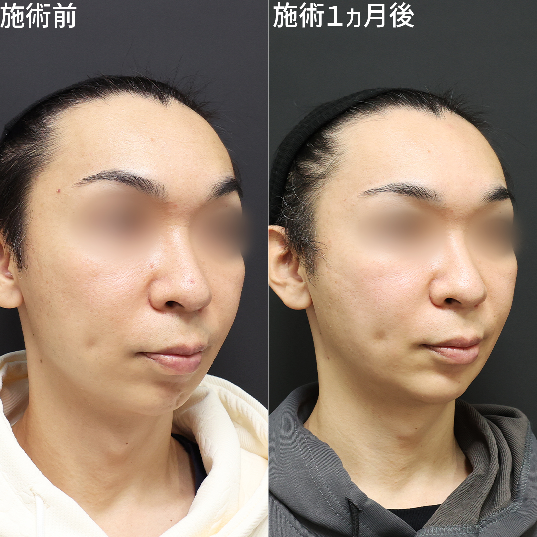 TAC式 ツヤ肌コラーゲンリフト®/顎のヒアルロン酸注射/眉間のしわ取りボトックス注射の症例写真 施術前後 