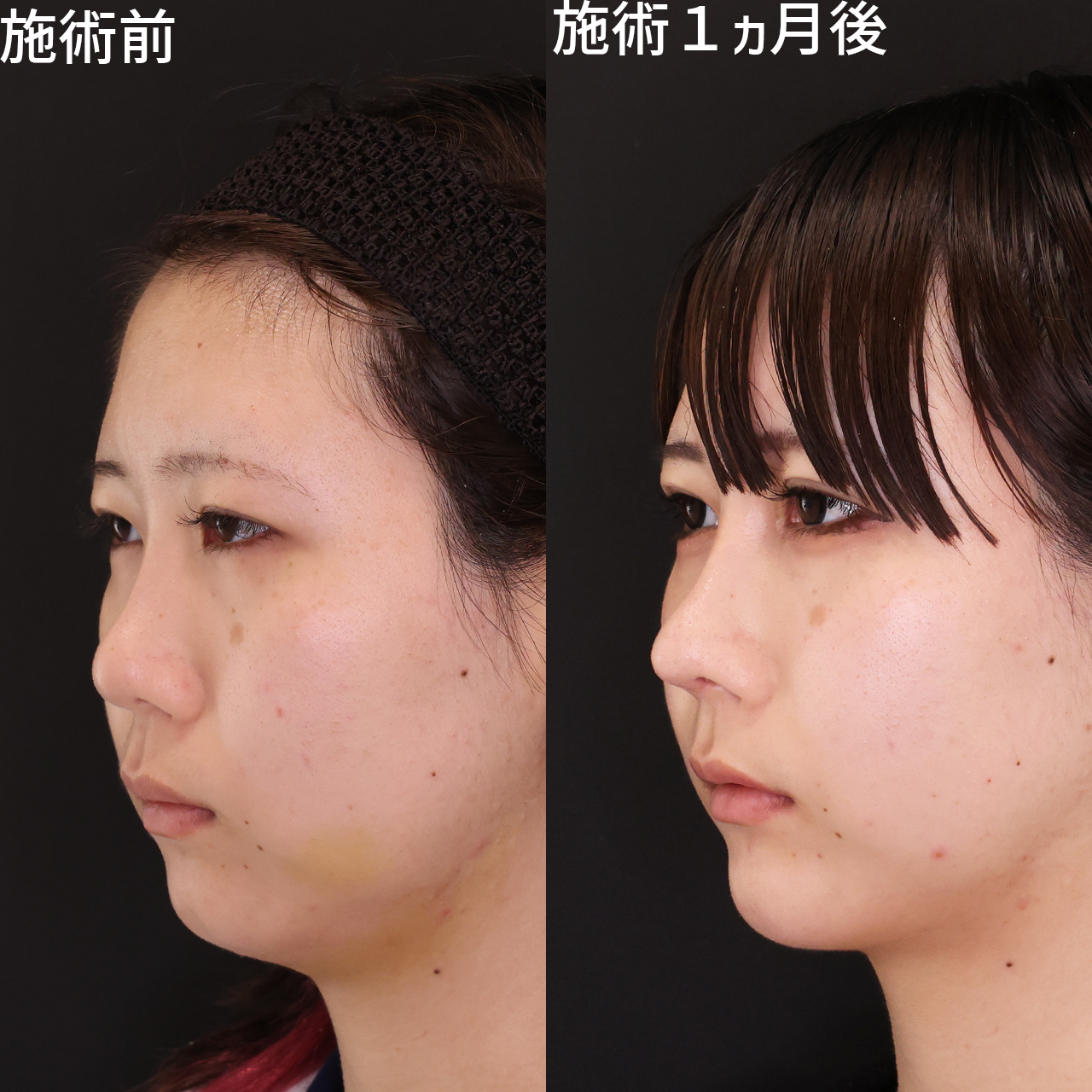 鼻中隔延長術/鼻先軟骨移植/鼻尖形成・鼻尖縮小の症例写真 施術前後 