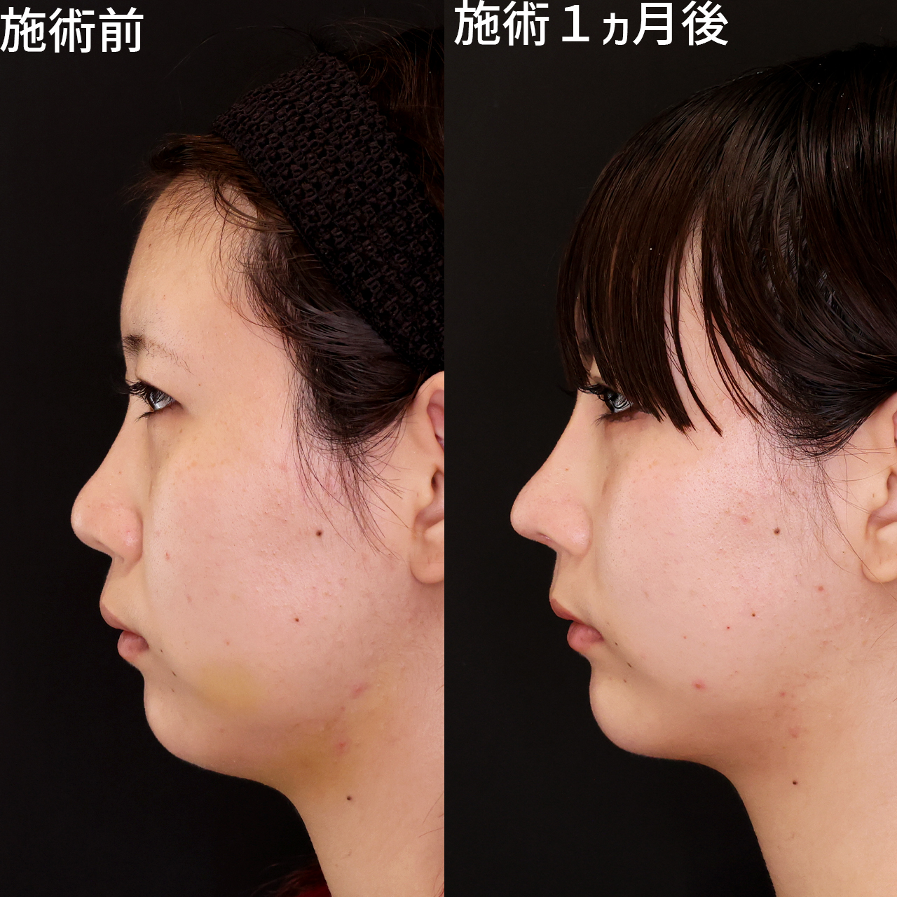 鼻中隔延長術/鼻先軟骨移植/鼻尖形成・鼻尖縮小の症例写真 施術前後 