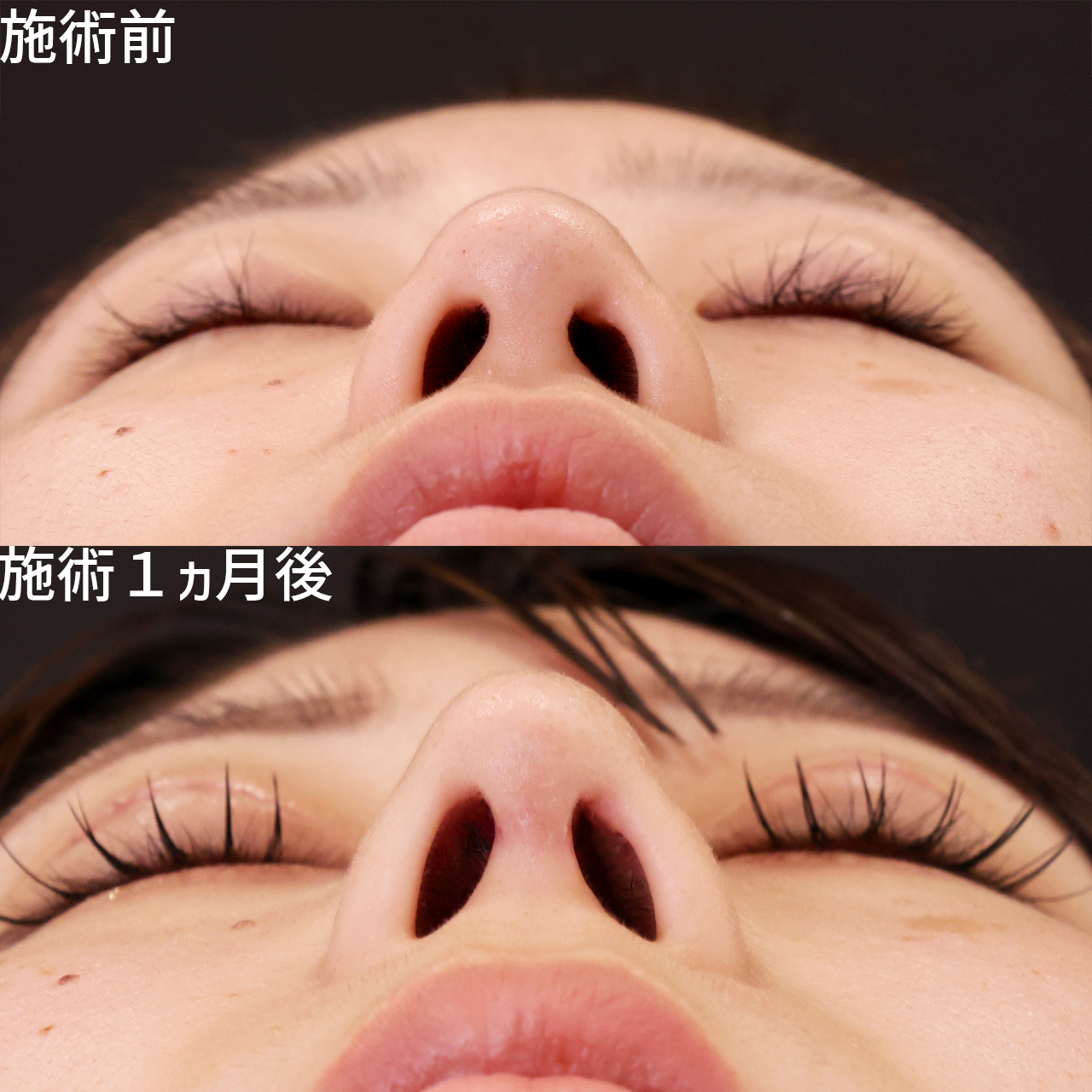 鼻中隔延長術/鼻先軟骨移植/鼻尖形成・鼻尖縮小の症例写真 施術前後 