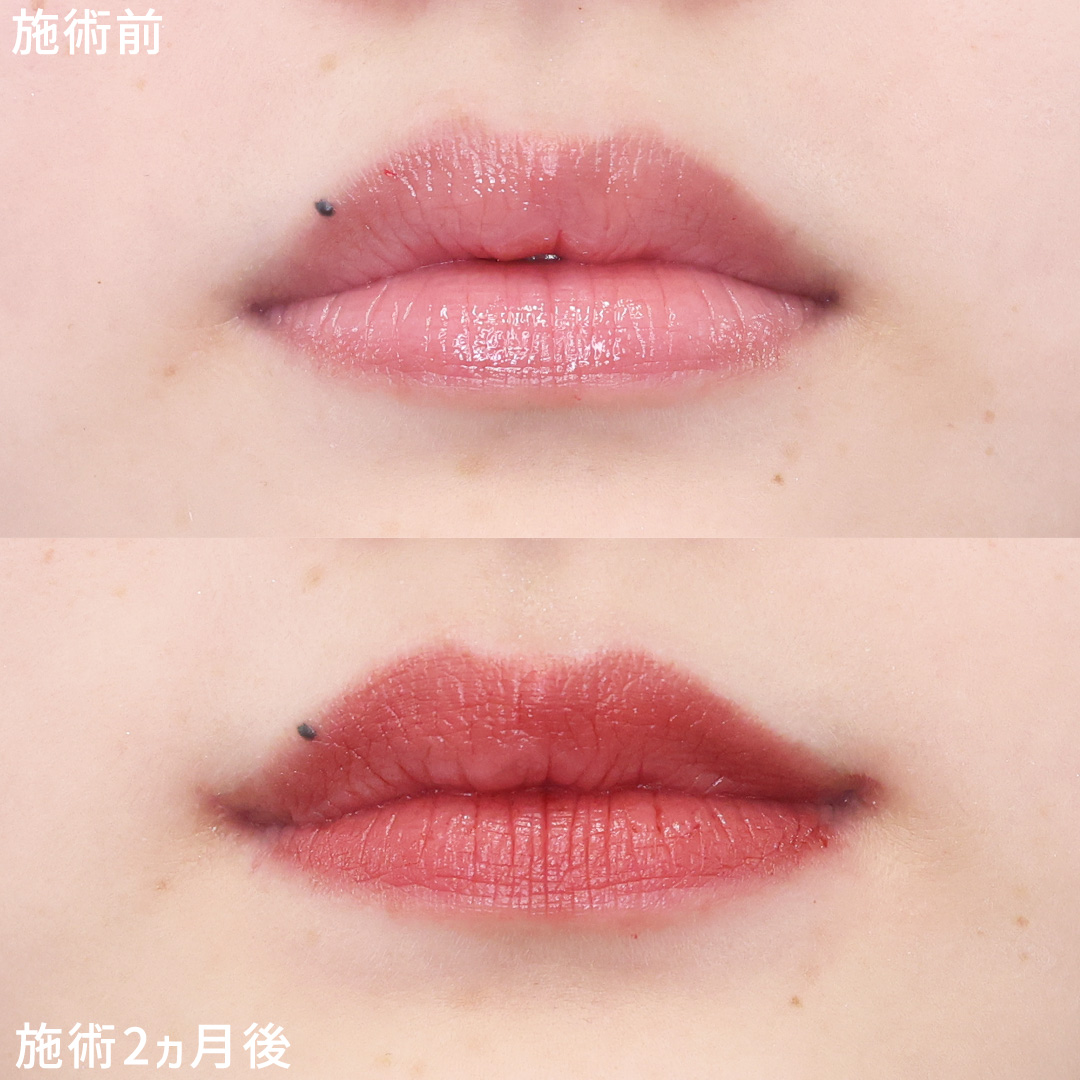 口角挙上・リフト（マイクロ切開法・内側法/口内法）の症例写真 施術前後 