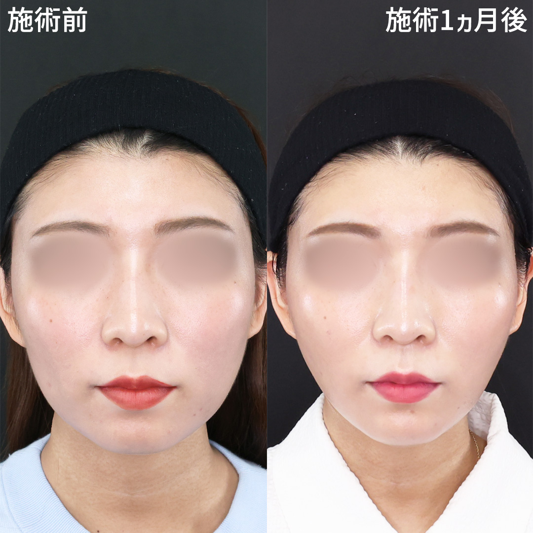 【糸リフトのみ】たるみを改善し卵型フェイスに