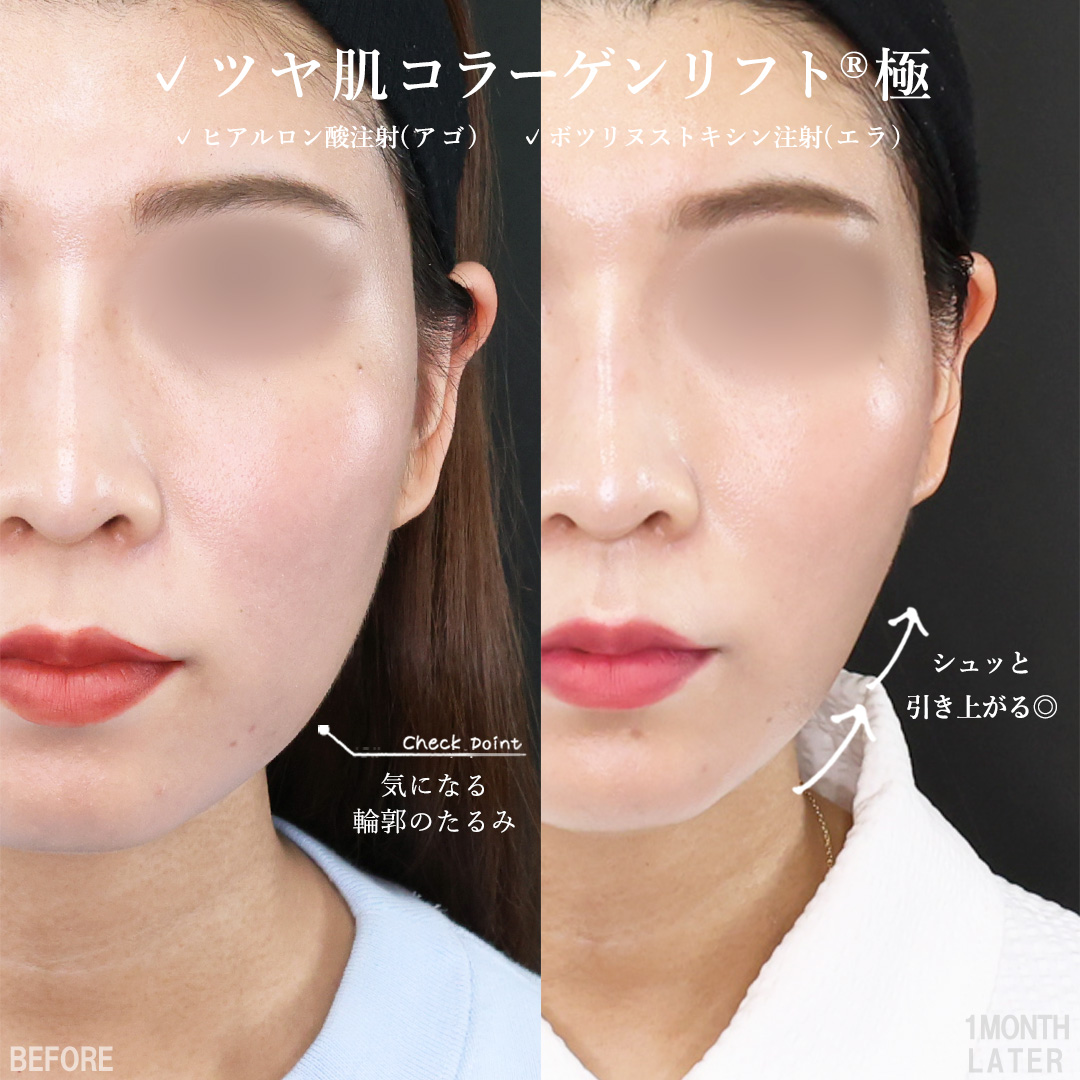 TAC式 ツヤ肌コラーゲンリフト®/顎のヒアルロン酸注射/エラボトックス注射の症例写真 施術前後 