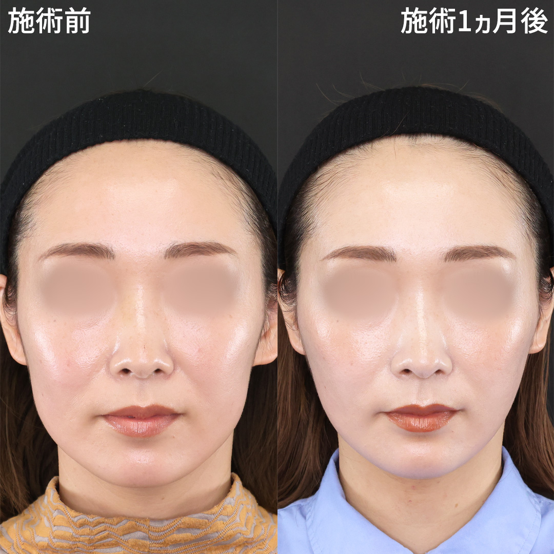 頬のポヨっと感を解消｜垢抜け小顔術