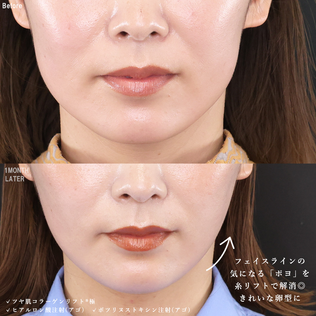 TAC式 ツヤ肌コラーゲンリフト®/顎のヒアルロン酸注射/ボトックス注射：その他の症例写真 施術前後 