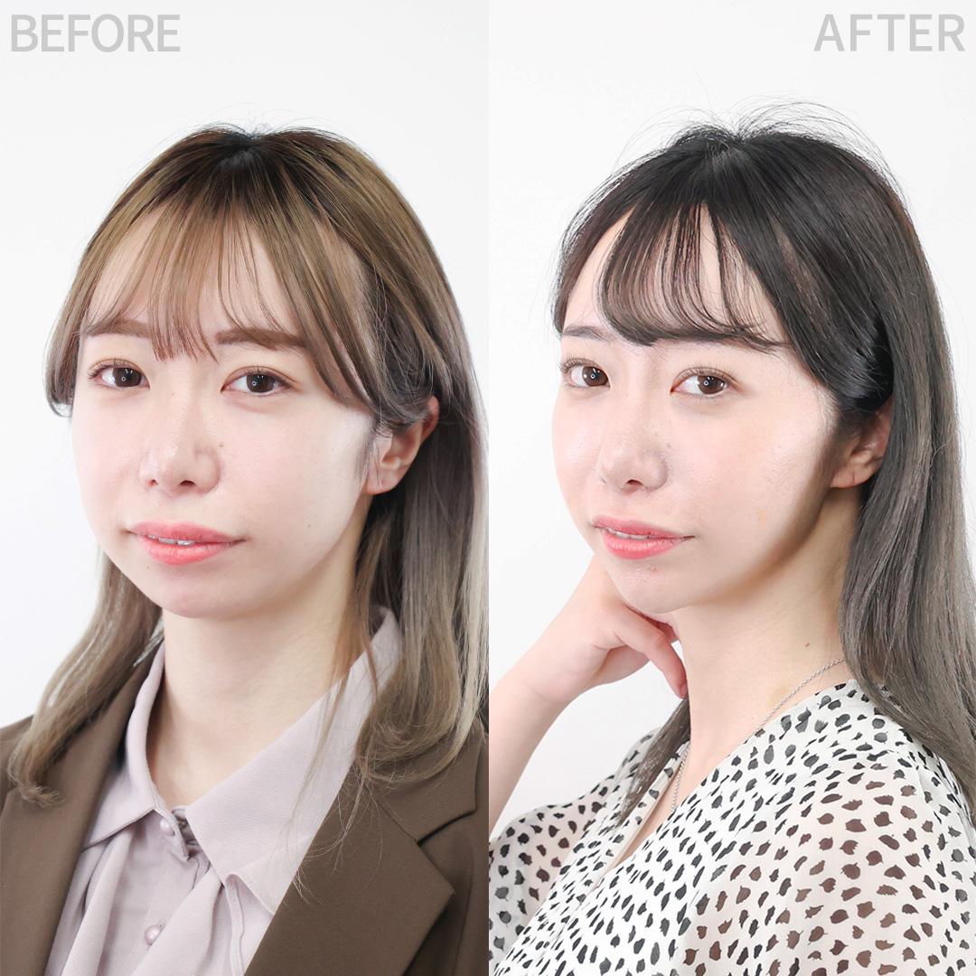 《脂肪除去×糸リフト》美を引き出す|卵型フェイスライン