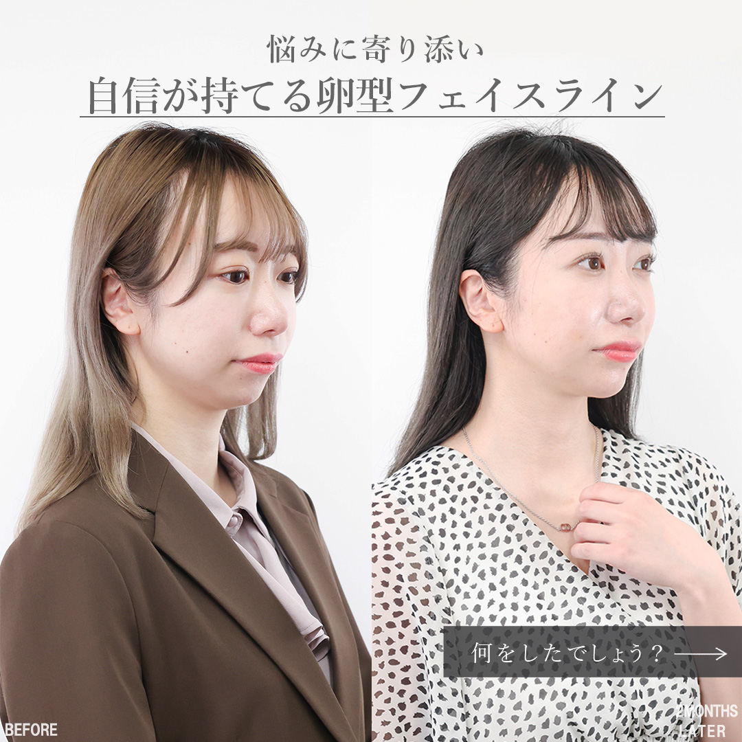 TAC式 ツヤ肌コラーゲンリフト®/バッカルファット除去/Lラインファット除去（エラ下脂肪除去）の症例写真 施術前後 