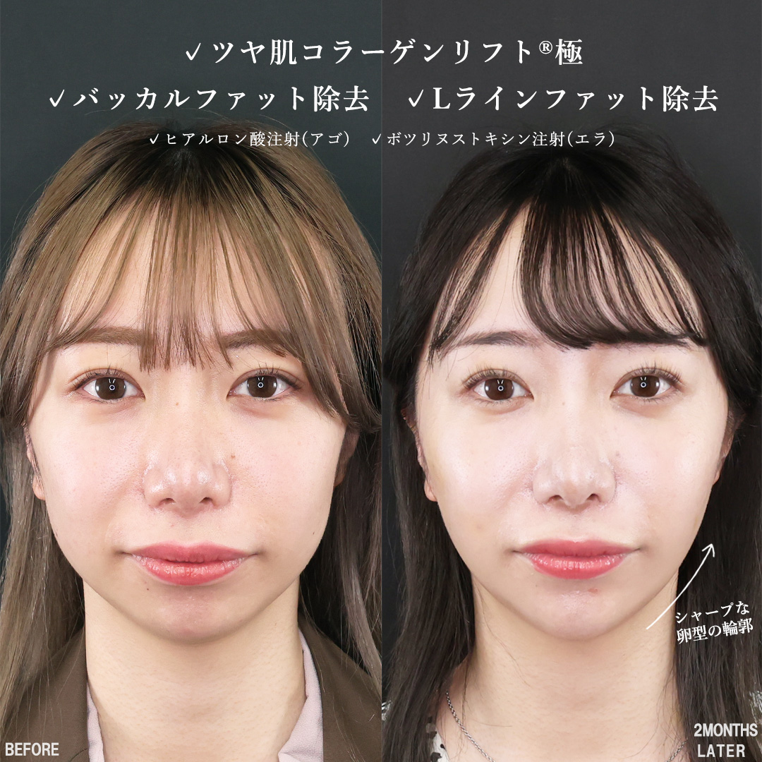 TAC式 ツヤ肌コラーゲンリフト®/バッカルファット除去/Lラインファット除去（エラ下脂肪除去）の症例写真 施術前後 