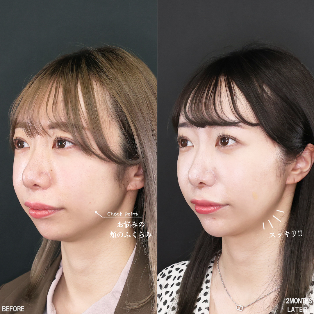TAC式 ツヤ肌コラーゲンリフト®/バッカルファット除去/Lラインファット除去（エラ下脂肪除去）の症例写真 施術前後 