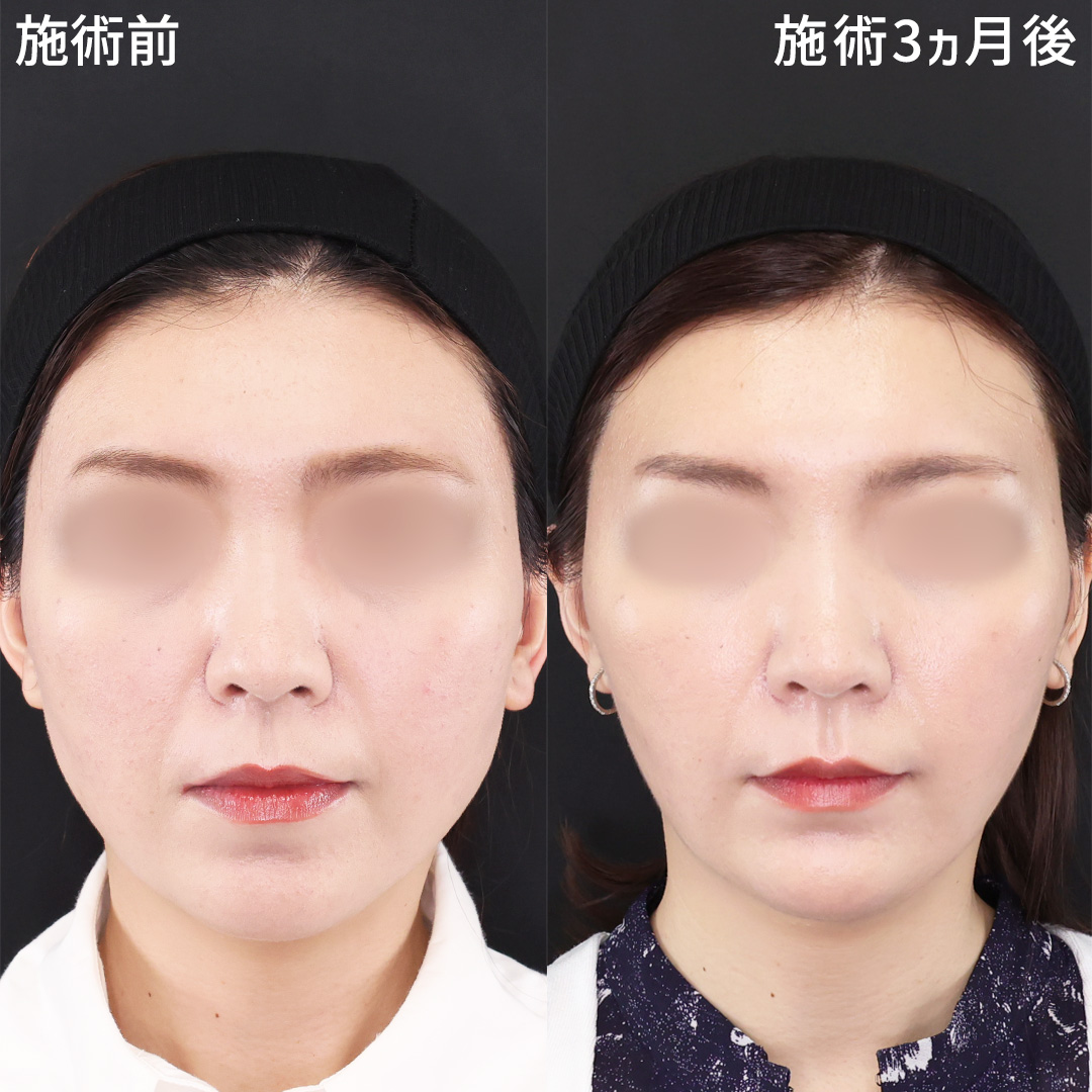 丸顔から卵型に｜フェイスラインを美しく整える小顔術