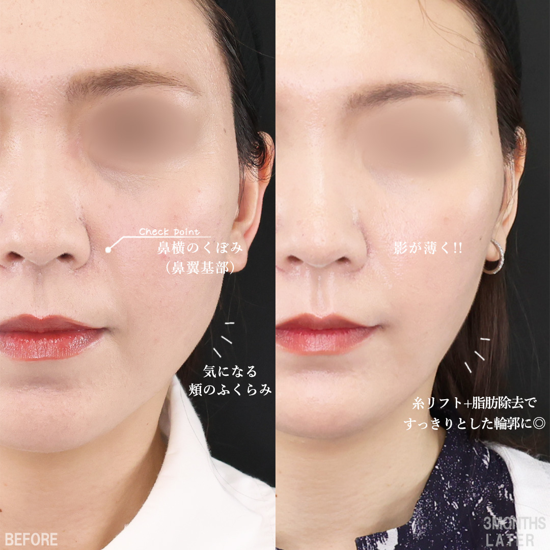 TAC式 ツヤ肌コラーゲンリフト®/TAC式 ショッピングリフト/Lラインファット除去（エラ下脂肪除去）の症例写真 施術前後 