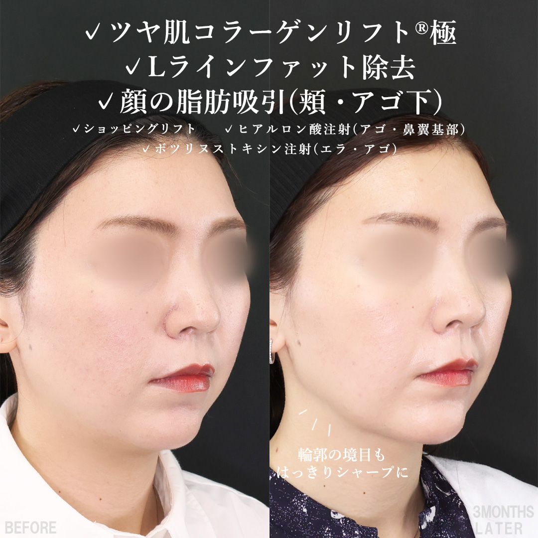 TAC式 ツヤ肌コラーゲンリフト®/TAC式 ショッピングリフト/Lラインファット除去（エラ下脂肪除去）の症例写真 施術前後 