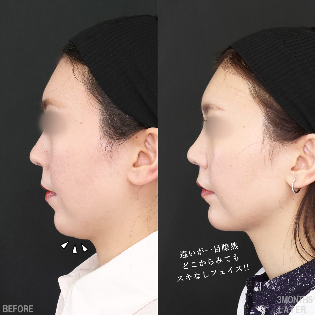 TAC式 ツヤ肌コラーゲンリフト®/TAC式 ショッピングリフト/Lラインファット除去（エラ下脂肪除去）の症例写真 施術前後 