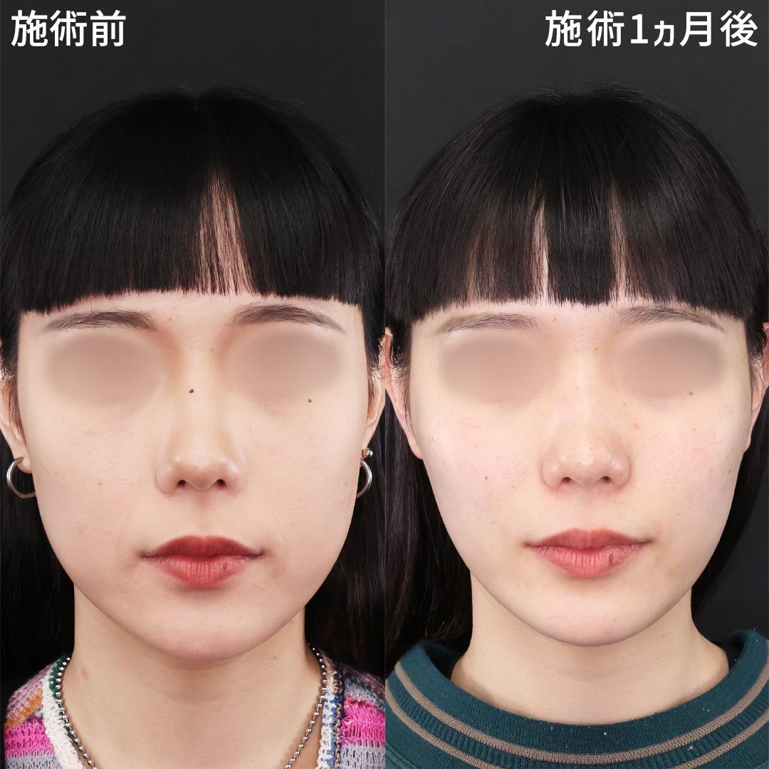 TAC式 ツヤ肌コラーゲンリフト®/エラボトックス注射の症例写真 施術前後