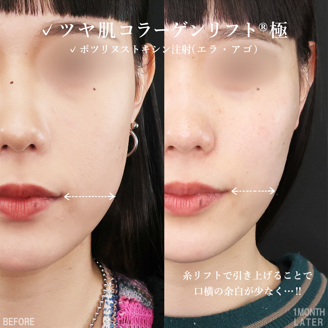 TAC式 ツヤ肌コラーゲンリフト®/エラボトックス注射の症例写真 施術前後