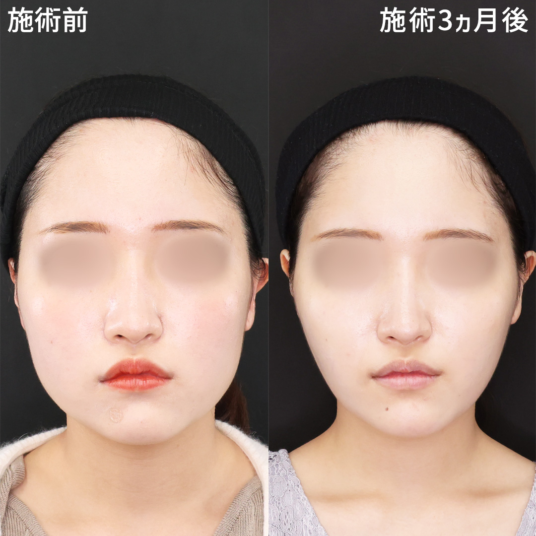 シュッと垢抜け｜モデル級小顔術《脂肪除去×糸リフト》